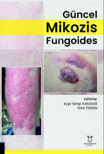Güncel Mikozis Fungoides