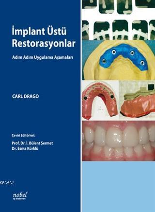 İmplant Üstü Restorasyonlar: Adım Adım Uygulama Aşamaları
